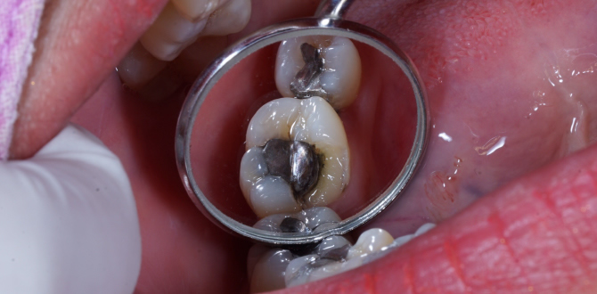 before-white-fillings-in-tottenham