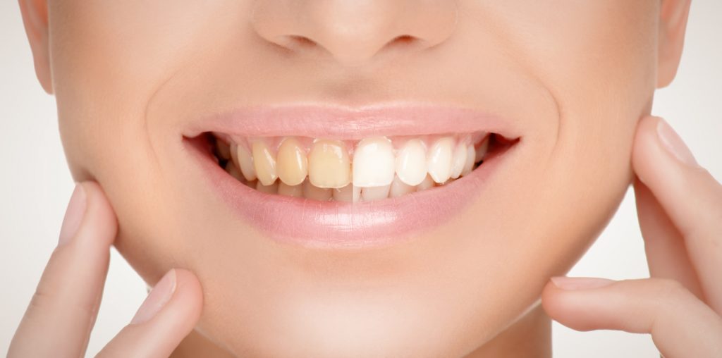 teeth whitening north london