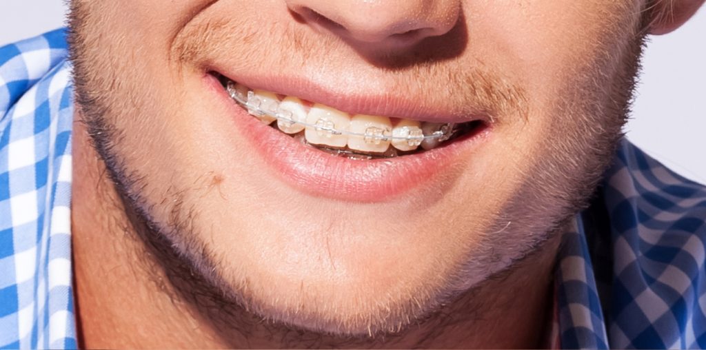 fixed braces near me