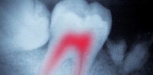 Root Canal Xray
