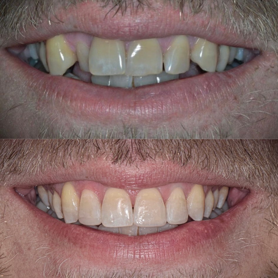 invisalign tottenham