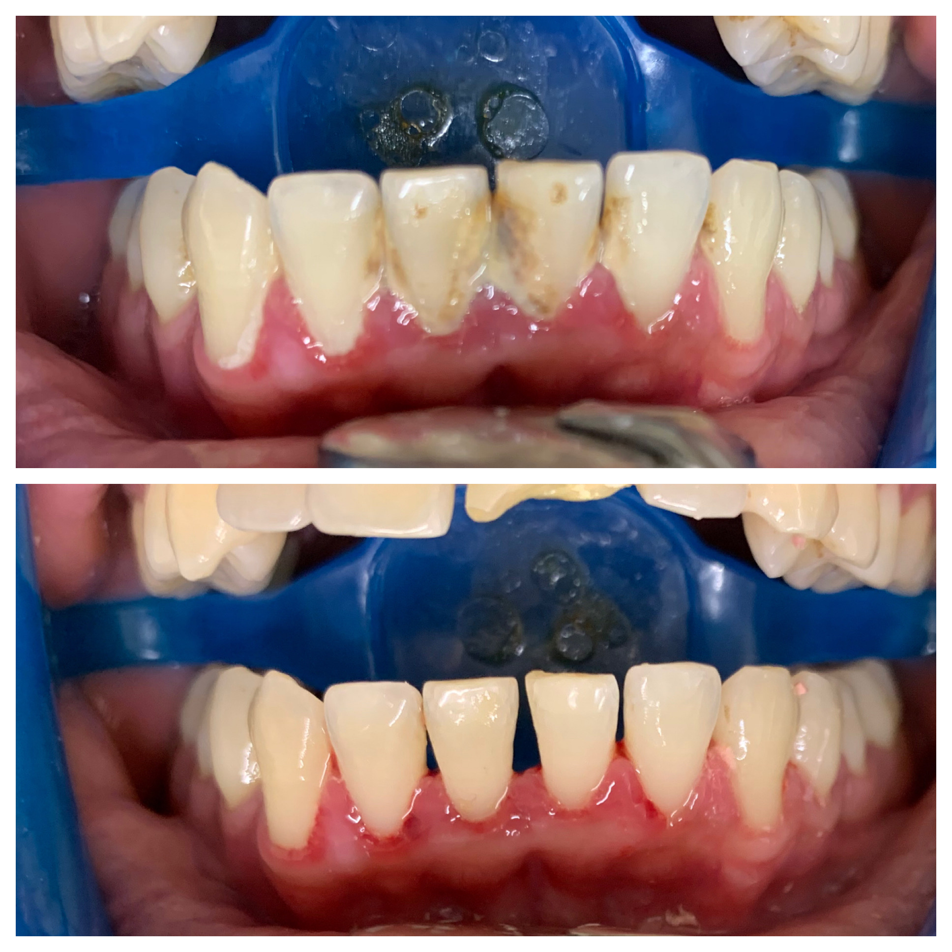 Dental Hygienist Tottenham, North London Scale & Polish