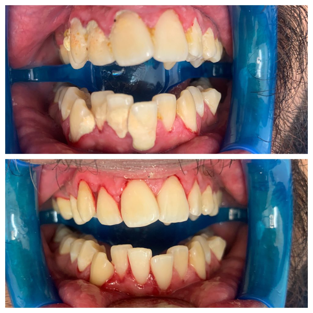 teeth cleaning near me