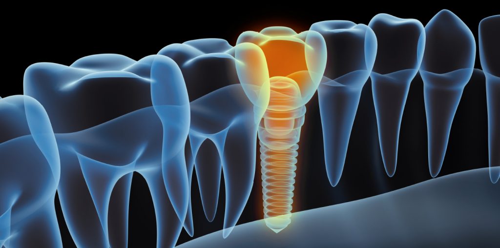 Dental Implants in Tottenham, North London Anna House Dental