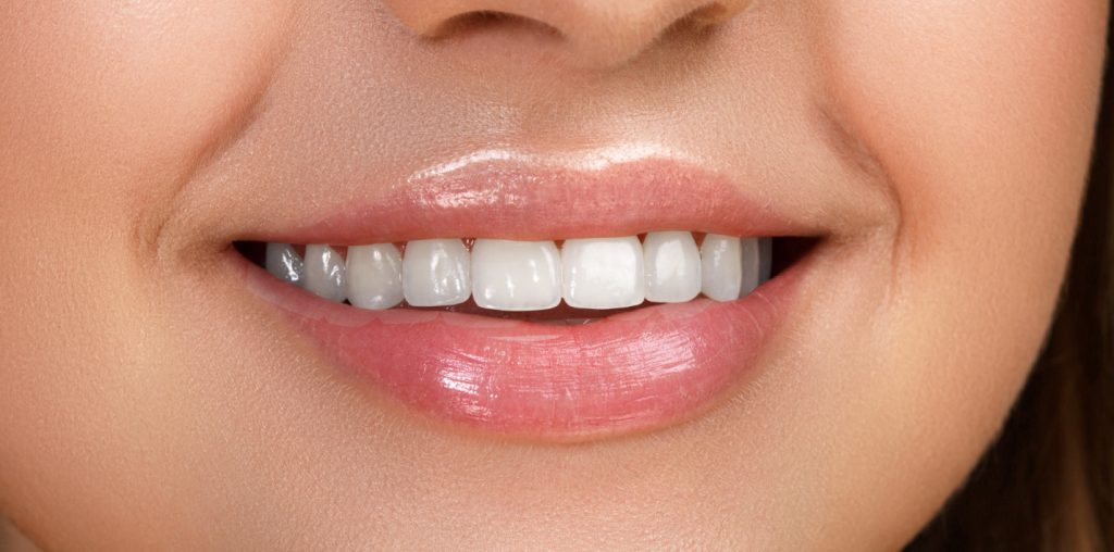 Dental Veneers in Tottenham North London Anna House