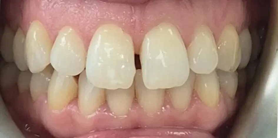 invisalign-before-1