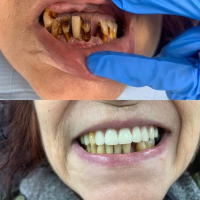 dentures north london